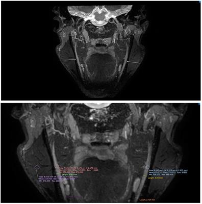 Facial Paresthesia, a Rare Manifestation of Hereditary Neuropathy With Liability to Pressure Palsies: A Case Report